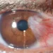La contaminación del aire eleva el riesgo de glaucoma y cataratas, alertan estudios recientes